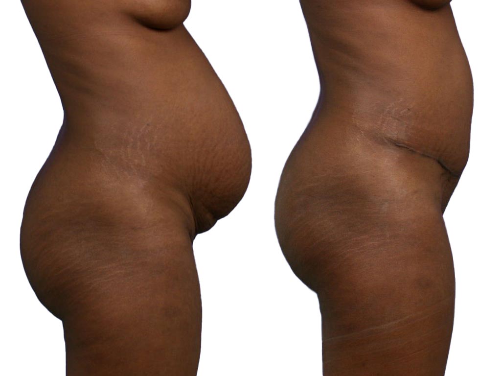 Abdominoplastie - CCL
